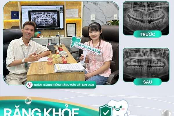 Dịch vụ niềng răng tại nha khoa Asia - Hành trình tạo nụ cười hoàn hảo