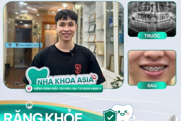 Cảm nhận khách hàng khi niềng răng tại Nha khoa Asia