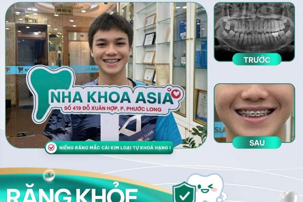 Hành trình thay đổi của bạn Nguyễn Thành Nghiệp khi niềng răng tại Nha khoa Asia
