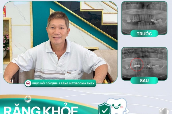 Review khách hàng bọc răng sứ thẩm mỹ tại Nha khoa Asia