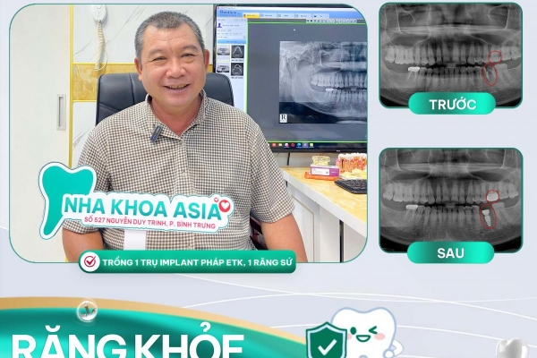 Trồng răng Implant ETK Pháp - Lựa chọn hoàn hảo của chú Thiện tại Nha khoa Asia