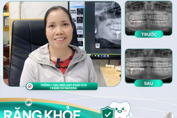 Công nghệ Implant ETK Pháp – Giải pháp trồng răng hiện đại, bền vững theo thời gian