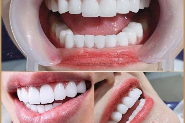 Bọc Răng Sứ Bao Lâu Thì Phải Làm Lại – 5 Dấu Hiệu Cảnh Báo Răng Sứ Xuống Cấp