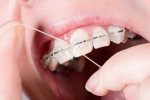 Niềng răng có dùng chỉ nha khoa được không? Giải đáp chi tiết từ Nha Khoa Asia