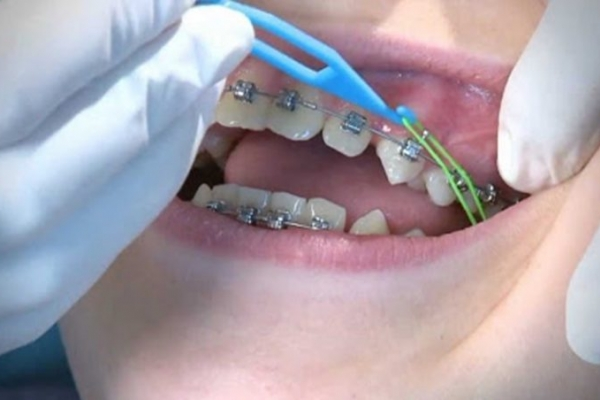 Phân biệt các loại chun trong niềng răng: Loại nào phù hợp với bạn nhất?