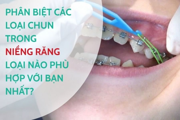 Phân biệt các loại chun trong niềng răng: Loại nào phù hợp với bạn nhất?