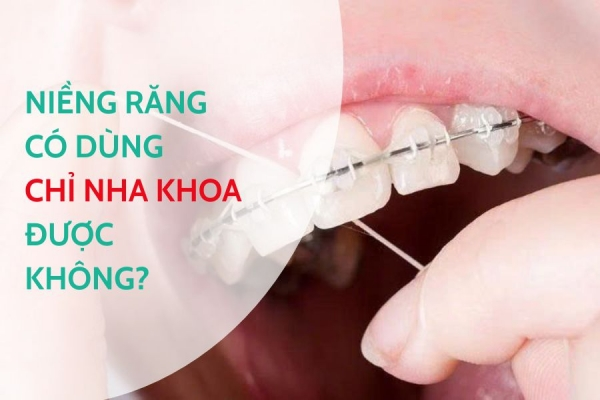 Niềng răng có dùng chỉ nha khoa được không? Giải đáp chi tiết từ Nha Khoa Asia