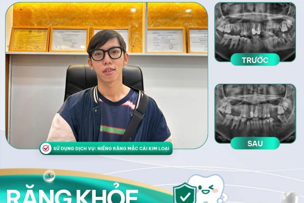 Niềng Răng Mắc Cài Kim Loại Tại Nha Khoa Asia – Giải Pháp Chỉnh Nha Hiệu Quả, Chi Phí Hợp Lý Bạn Nguyễn Ngọc Hiền Tin Chọn