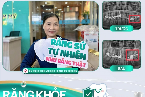 Cảm Nhận Cô Lưu Thị Mị Khi Bọc Răng Sứ Cercon HT Tại Nha Khoa Asia