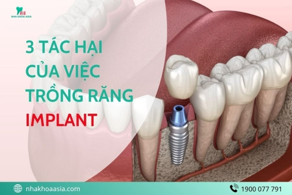 3 Tác Hại Của Việc Trồng Răng Implant Có Thể Bạn Chưa Biết: Phân Tích Rủi Ro Của Trồng Răng Implant