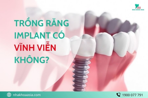 Trồng Răng Implant Có Vĩnh Viễn Không? Phân Tích Độ Bền Và Kinh Nghiệm Chăm Sóc