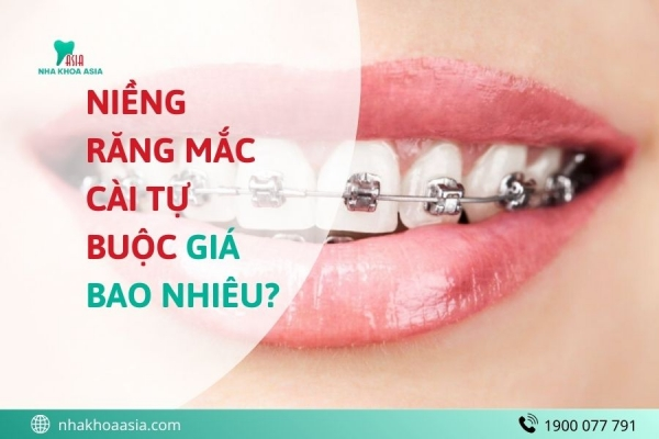 Niềng Răng Mắc Cài Tự Buộc Giá Bao Nhiêu? Khác Gì So Với Mắc Cài Thường