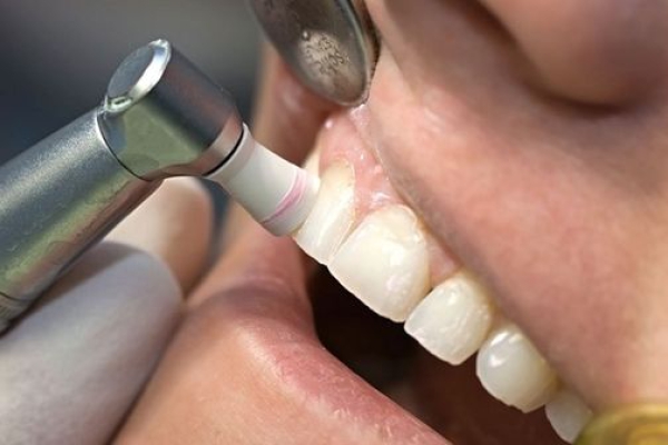 Lấy vôi răng bao nhiêu tiền? chi phí cụ thể nhất bạn không thể bỏ lỡ