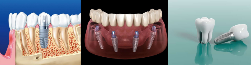 Dịch vụ trồng răng implant