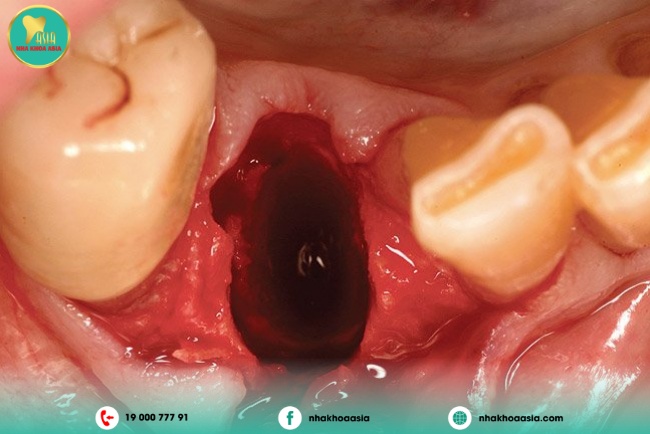 Kiến thức “bỏ túi” sau khi nhổ răng khôn