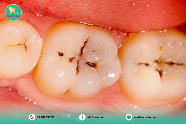 Răng cấm bị sâu răng