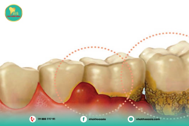  Răng khôn bị bám thức ăn