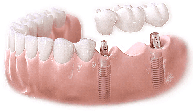 Làm sao để lựa chọn Trụ Implant phù hợp với bản thân?
