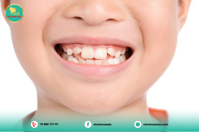 Phương pháp niềng răng sớm nào tốt nhất cho trẻ