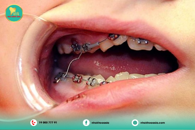 Sự tổn thương các mô mềm