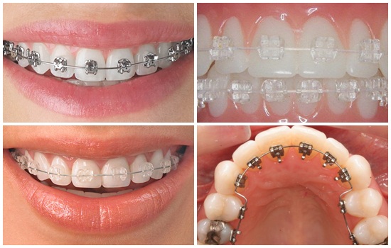 Các phương pháp niềng răng phổ biến nhất hiện nay