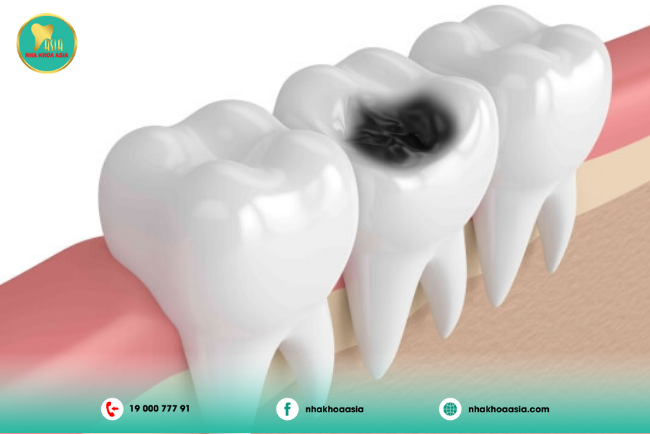 Nguyên nhân khiến răng sau điều trị tủy vẫn đau nhức, thối và hoại tử