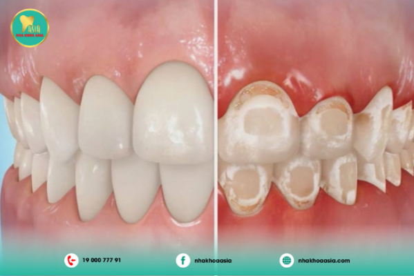 Răng bị mất canxi
