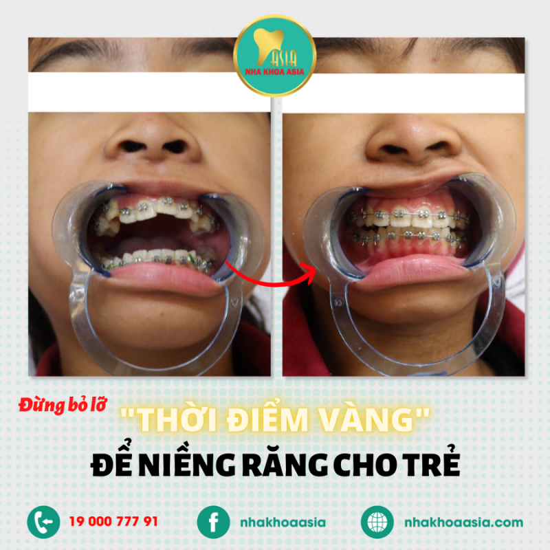 thời điểm vàng để niềng răng