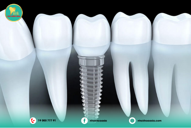 trồng răng implant