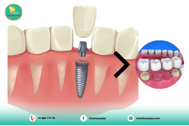 ưu điểm của trồng răng Implant so với bắc cầu sứ