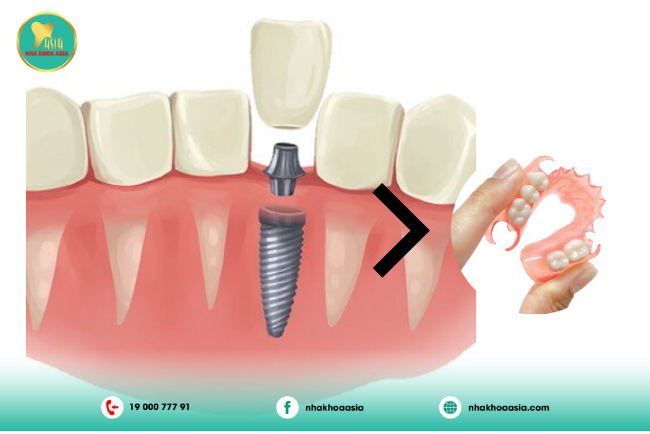 ưu điểm của trồng răng implant so với hàm tháo lắp