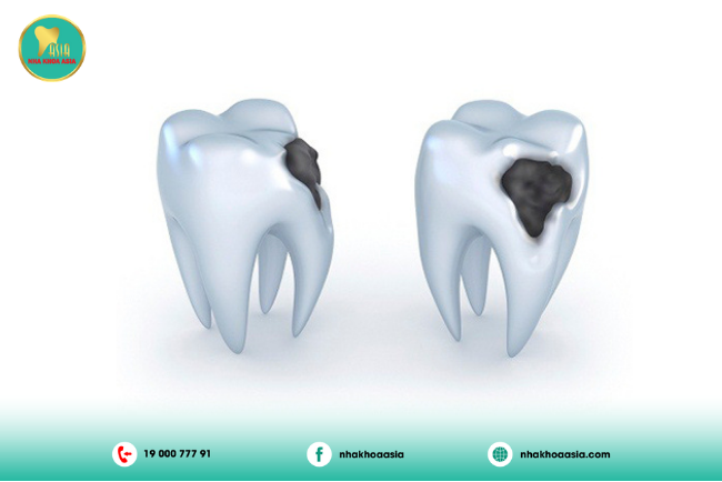 Viêm tủy răng giai đoạn 1