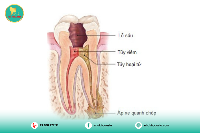 Viêm tủy răng giai đoạn 2