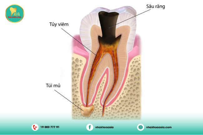 Viêm tủy răng giai đoạn 3