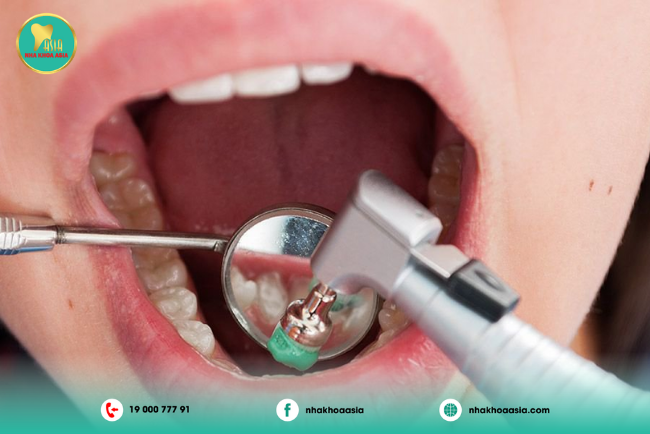 quá trình cạo vôi răng