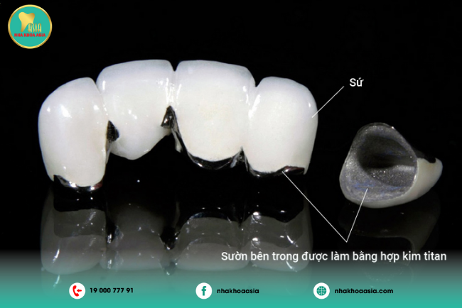 răng sứ kim loại