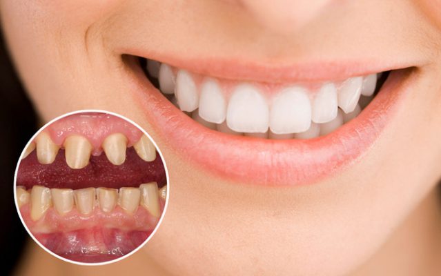 Bọc răng sứ loại nào tốt nhất? Đánh giá từ chuyên gia nha khoa nổi tiếng