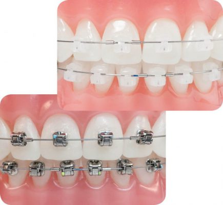 Mắc Cài Sứ Là Gì? Những Điều Cần Biết Khi Niềng Răng