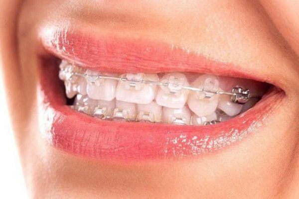 Mắc Cài Sứ Là Gì? Những Điều Cần Biết Khi Niềng Răng