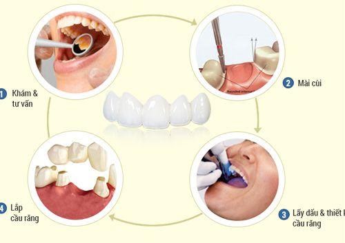 Quy trình bọc răng sứ như nào là chuẩn và đảm bảo an toàn 