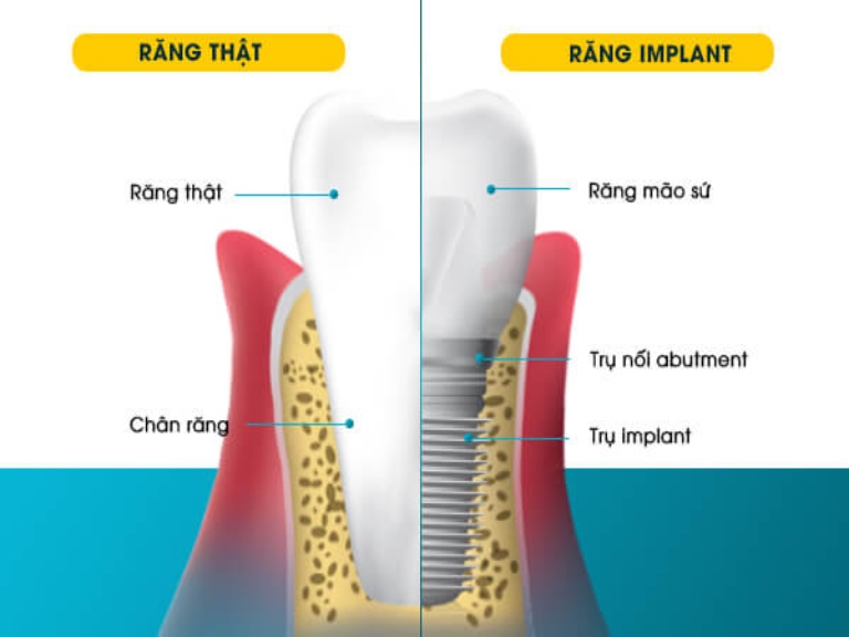 8 lợi ích tuyệt vời của trồng răng implant giá rẻ mà bạn không thể bỏ qua