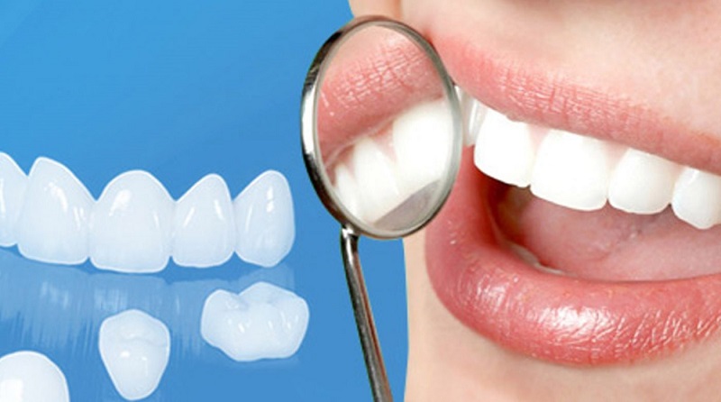Răng bọc sứ là gì?