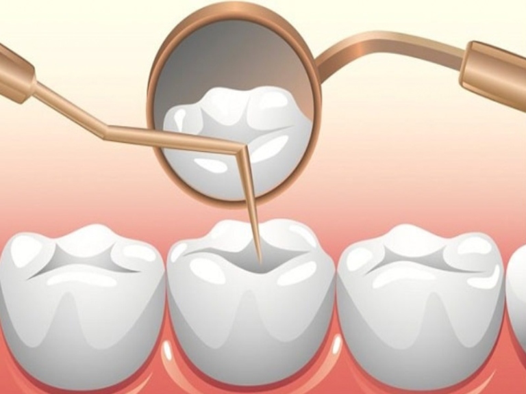 Có cần thay thế trám răng sau một thời gian sử dụng?
