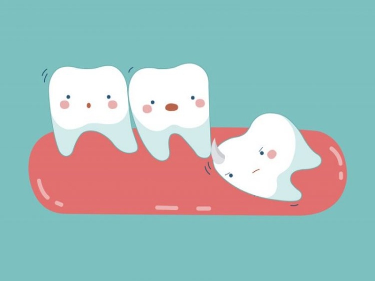  Nhổ răng khôn giá rẻ : Tìm hiểu về các loại và cách sử dụng