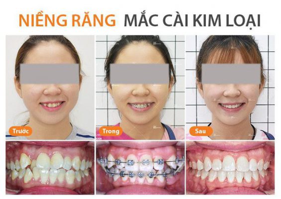 mắc cài kim loại,