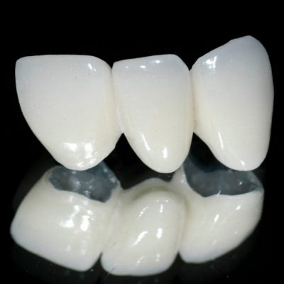 Bọc răng sứ loại nào tốt nhất? Đánh giá từ chuyên gia nha khoa nổi tiếng