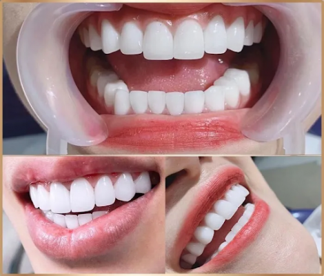 Trám răng sứ thẩm mỹ là gì? Bọc sứ hay trám răng mang hiệu quả hơn?