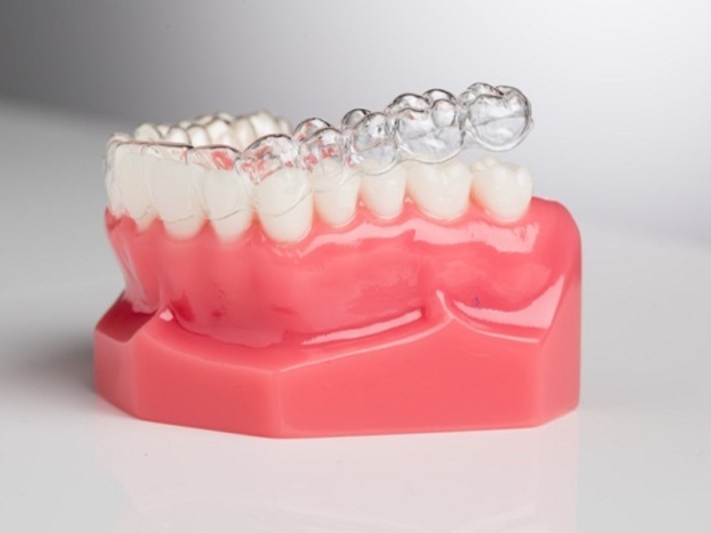 Quy trình niềng răng 3D Clear chuẩn Nha Khoa Asia