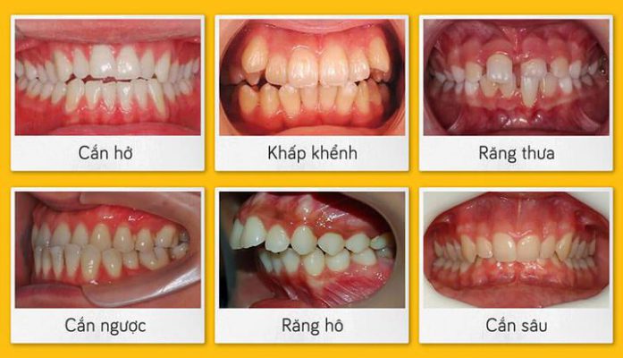 răng mắc cài kim loại