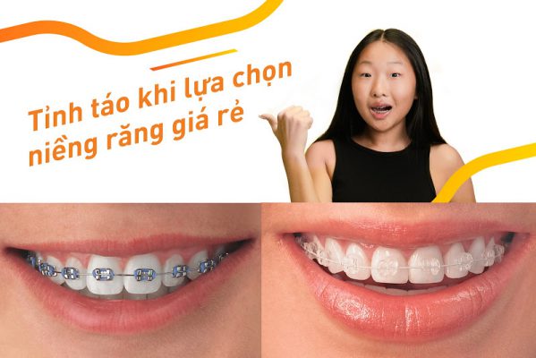 chi phí niềng răng